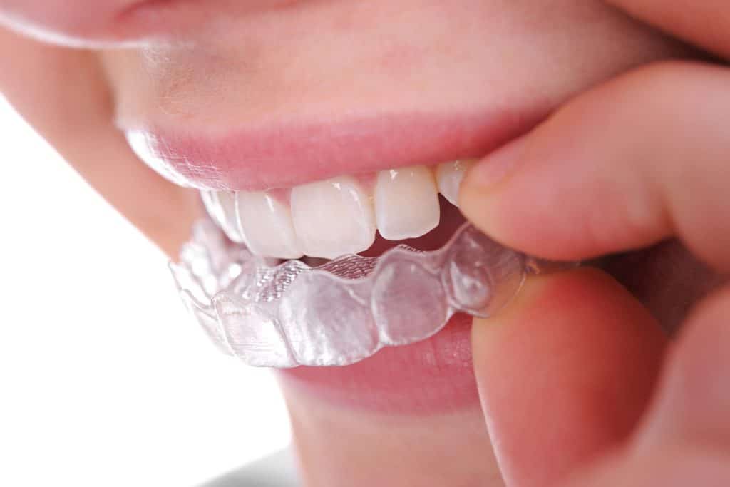 Could I Be a Candidate for Invisalign?